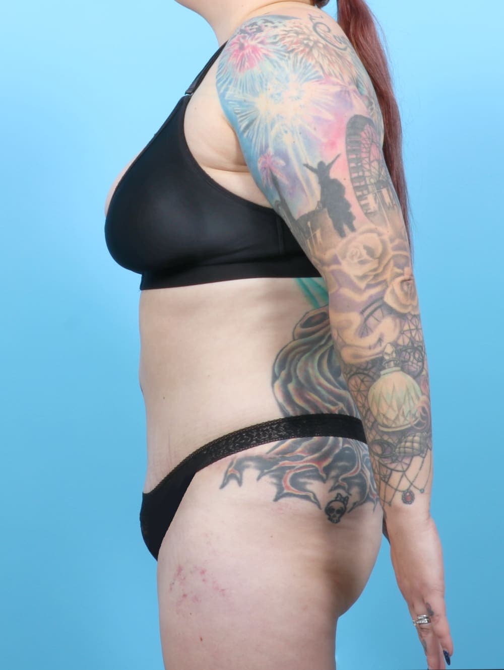 Tummy Tuck case #6325 after, image 4