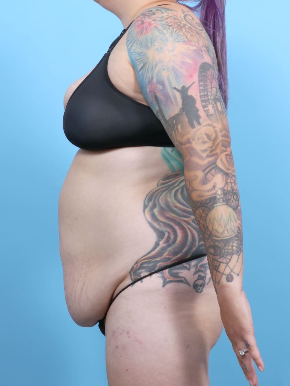 Tummy Tuck case #6325 before, image 4