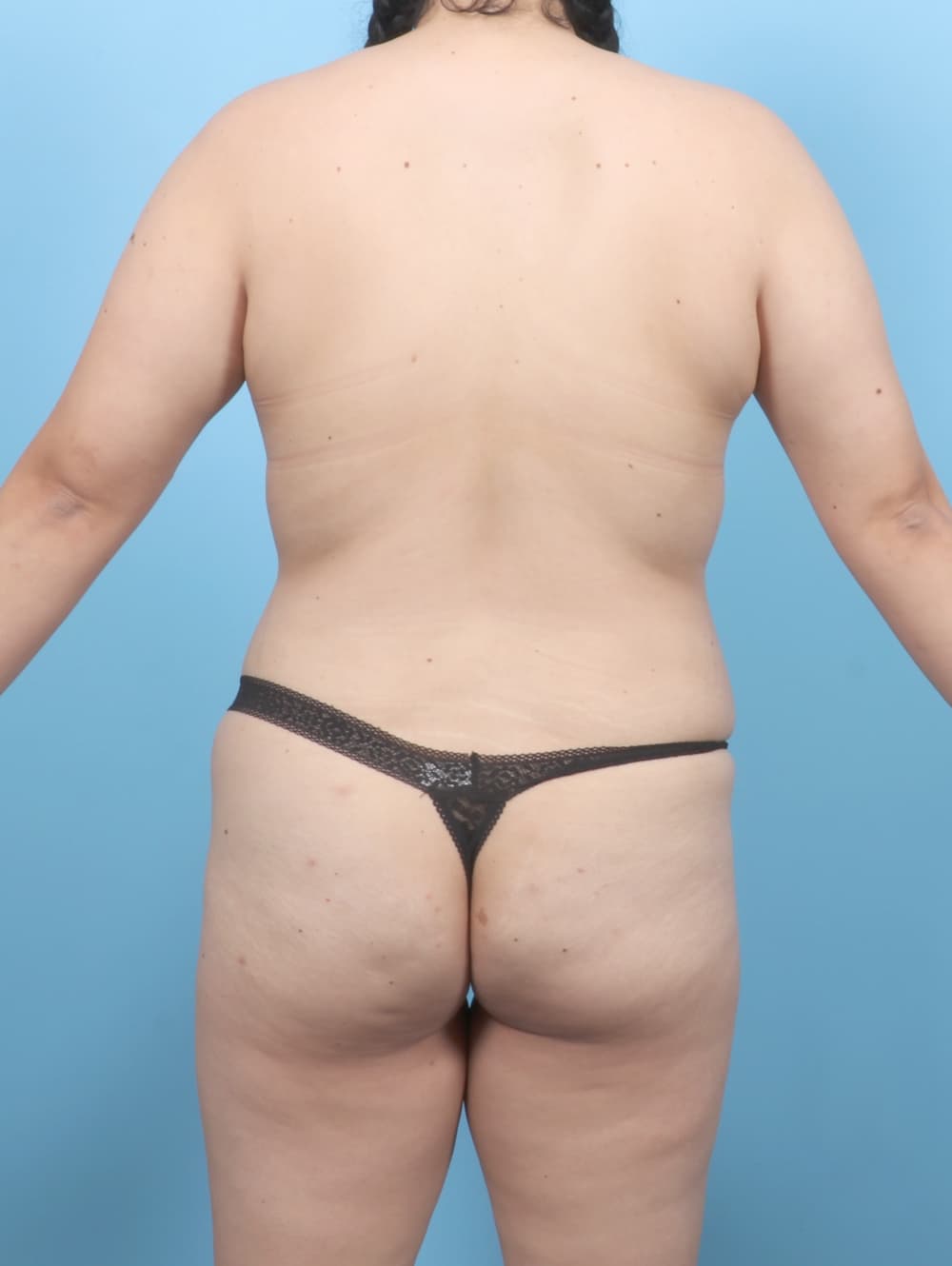 Breast Augmentation case #8902 before, image 4