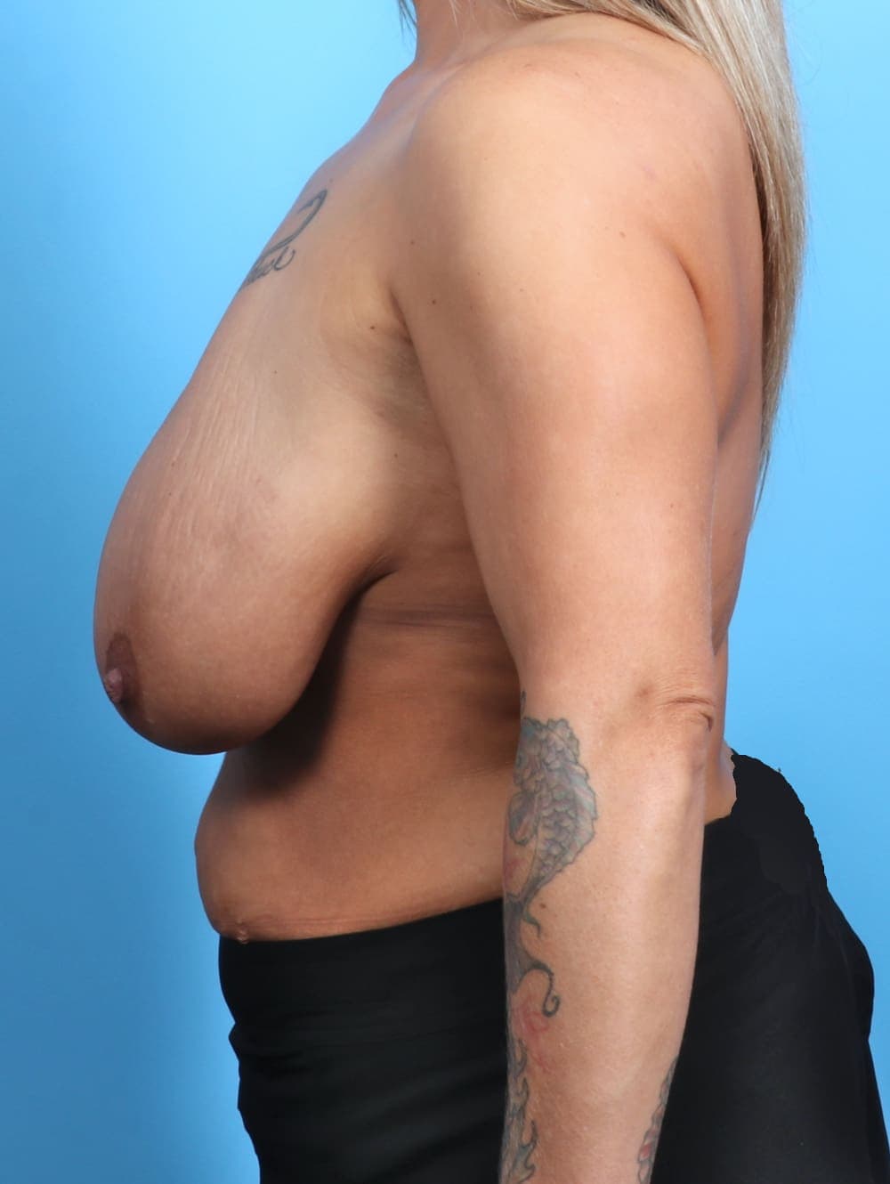 Breast Lift/Reduction case #3444 before, image 3