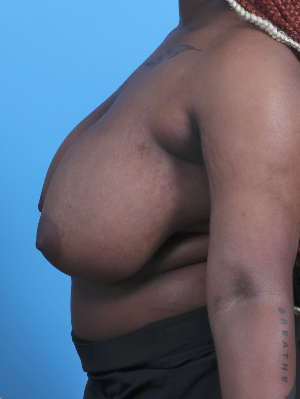 Breast Lift/Reduction case #4561 before, image 3