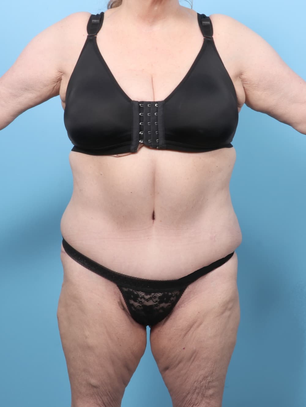 Tummy Tuck case #8511 after