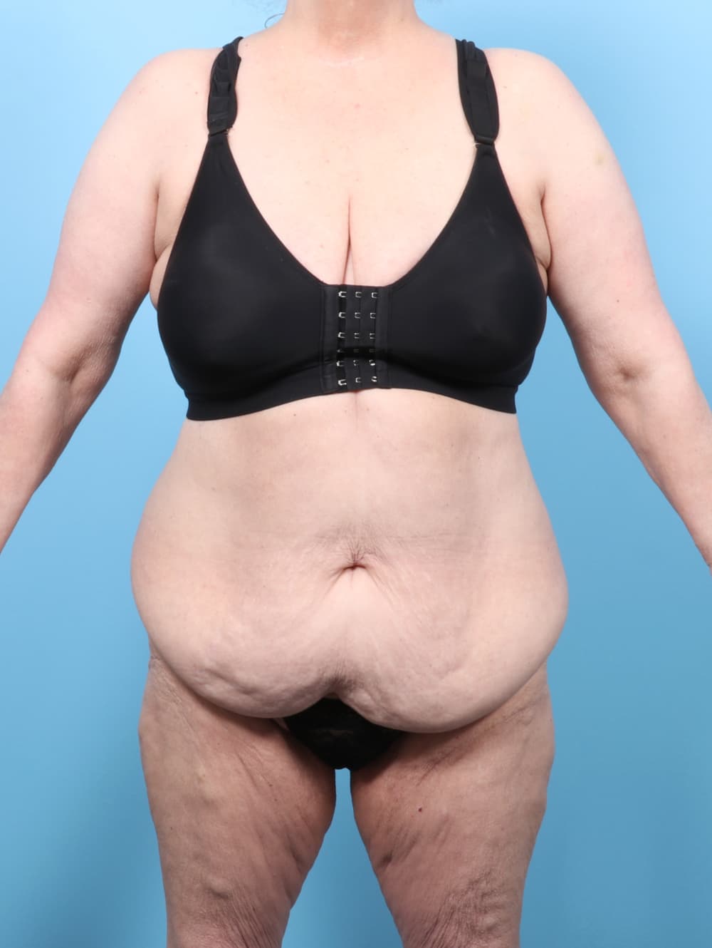 Tummy Tuck case #8511 before