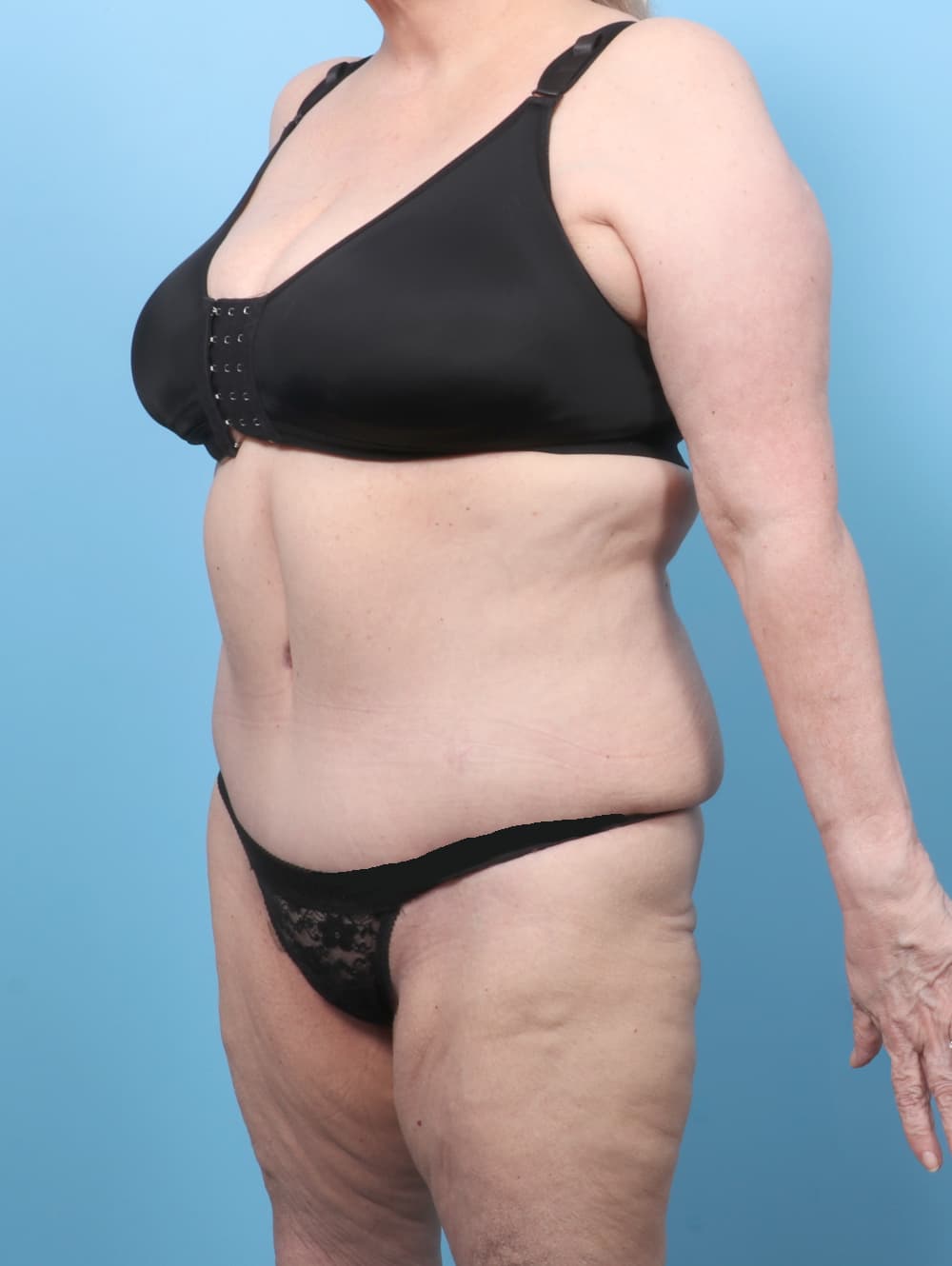 Tummy Tuck case #8511 after, image 2
