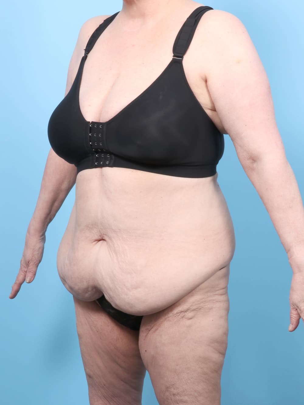 Tummy Tuck case #8511 before, image 2