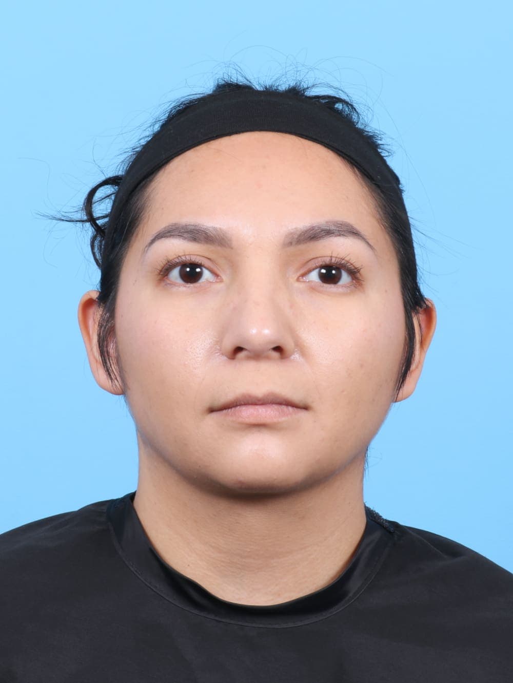 Liposuction case #6531 after, image 2