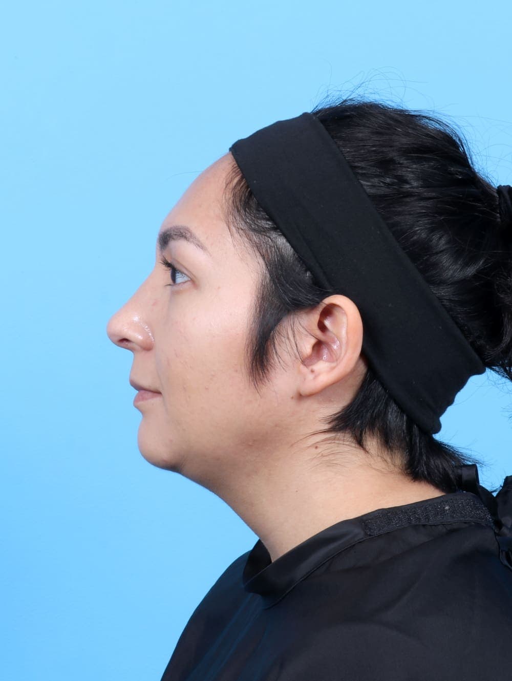 Liposuction case #6531 after