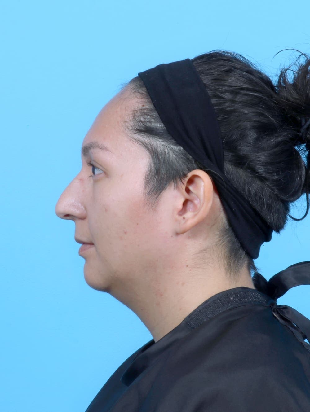 Liposuction case #6531 before