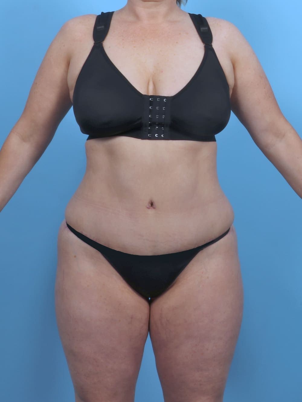 Tummy Tuck case #5092 after, image 1