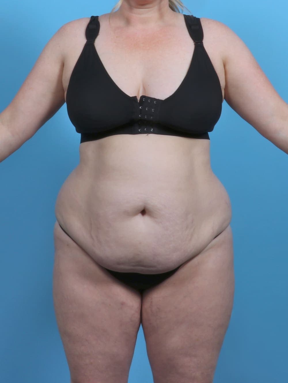 Tummy Tuck case #5092 before, image 1