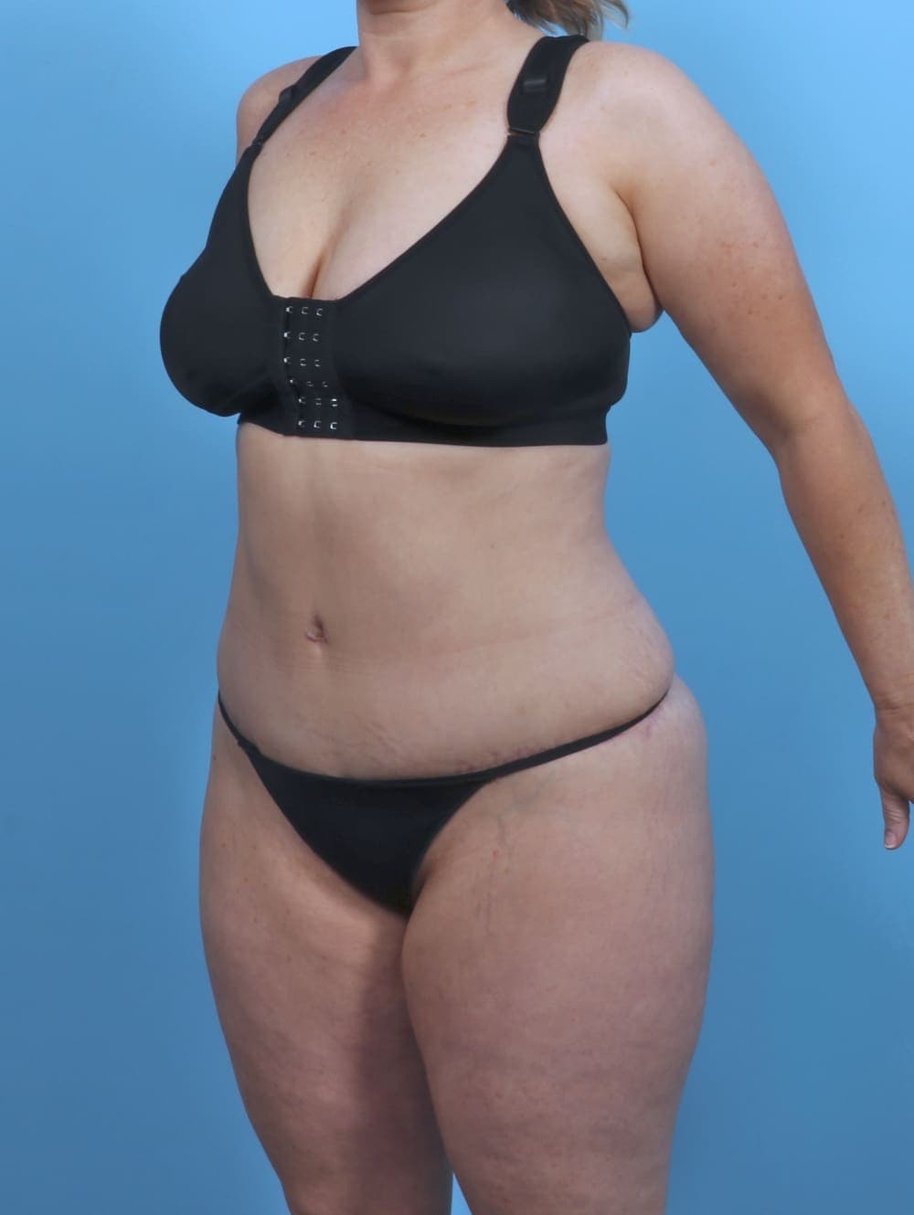 Tummy Tuck case #5092 after, image 2