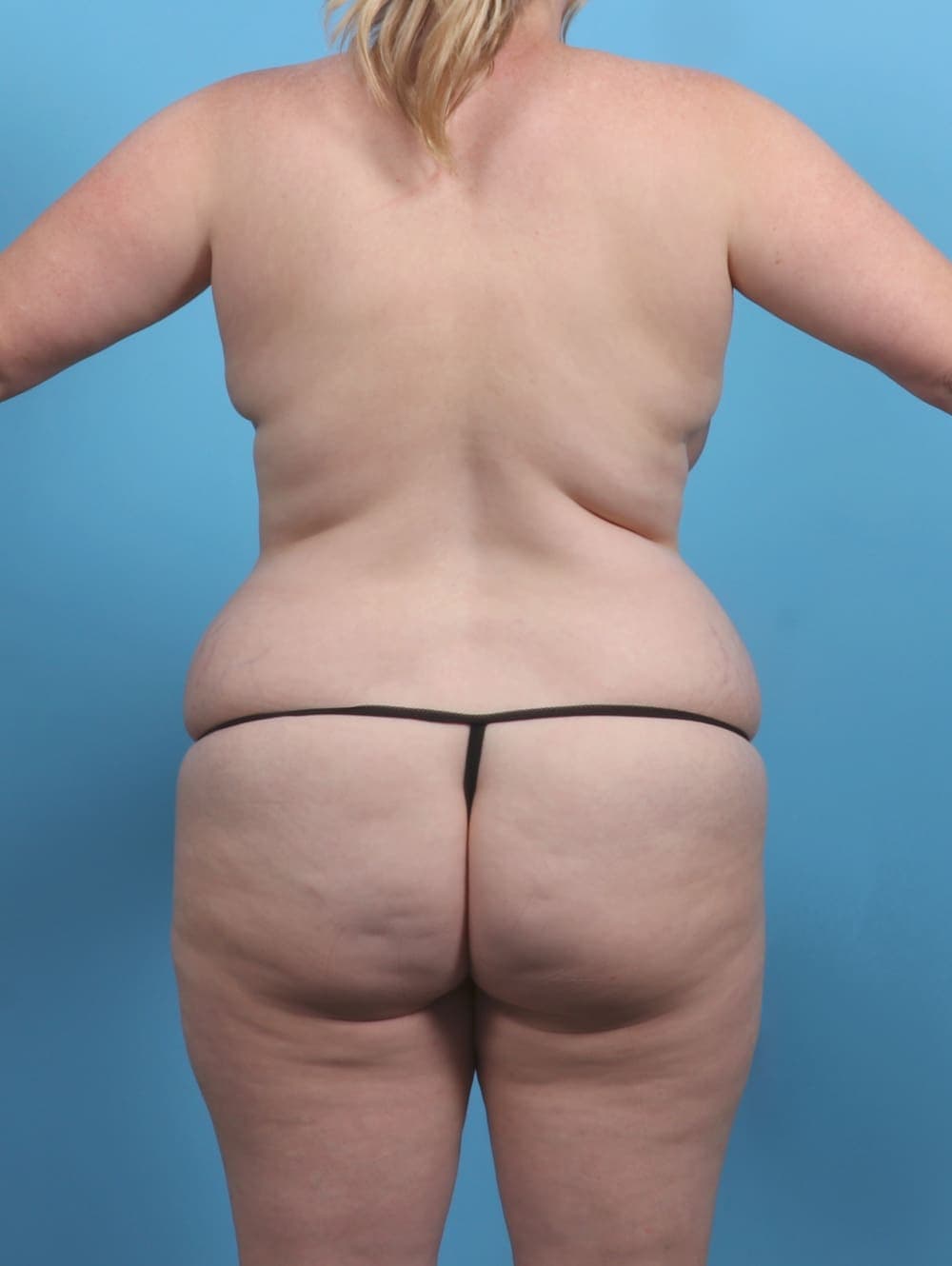 Tummy Tuck case #5092 before, image 4