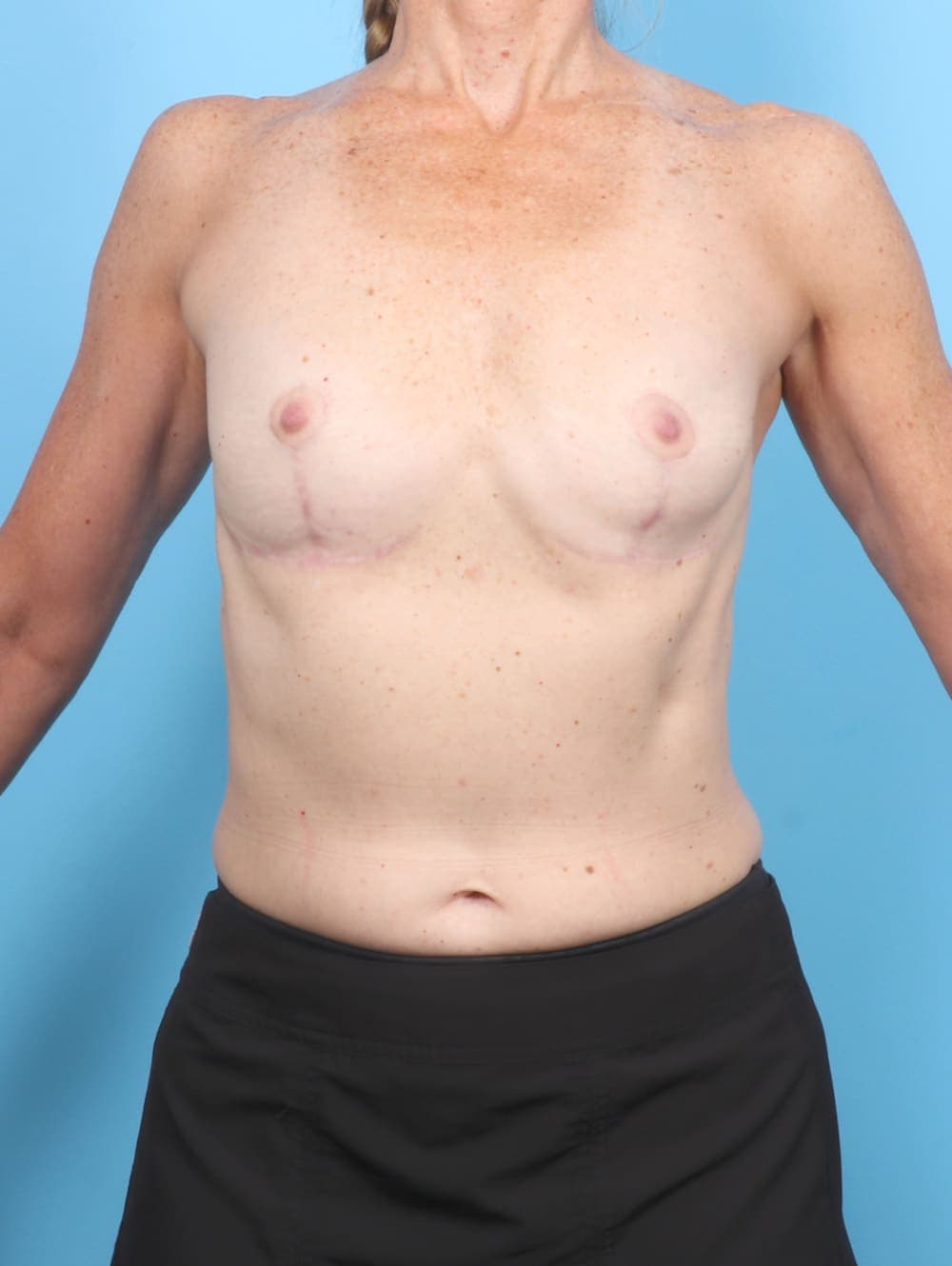 Breast Implant Removal with Lift case #6933 after