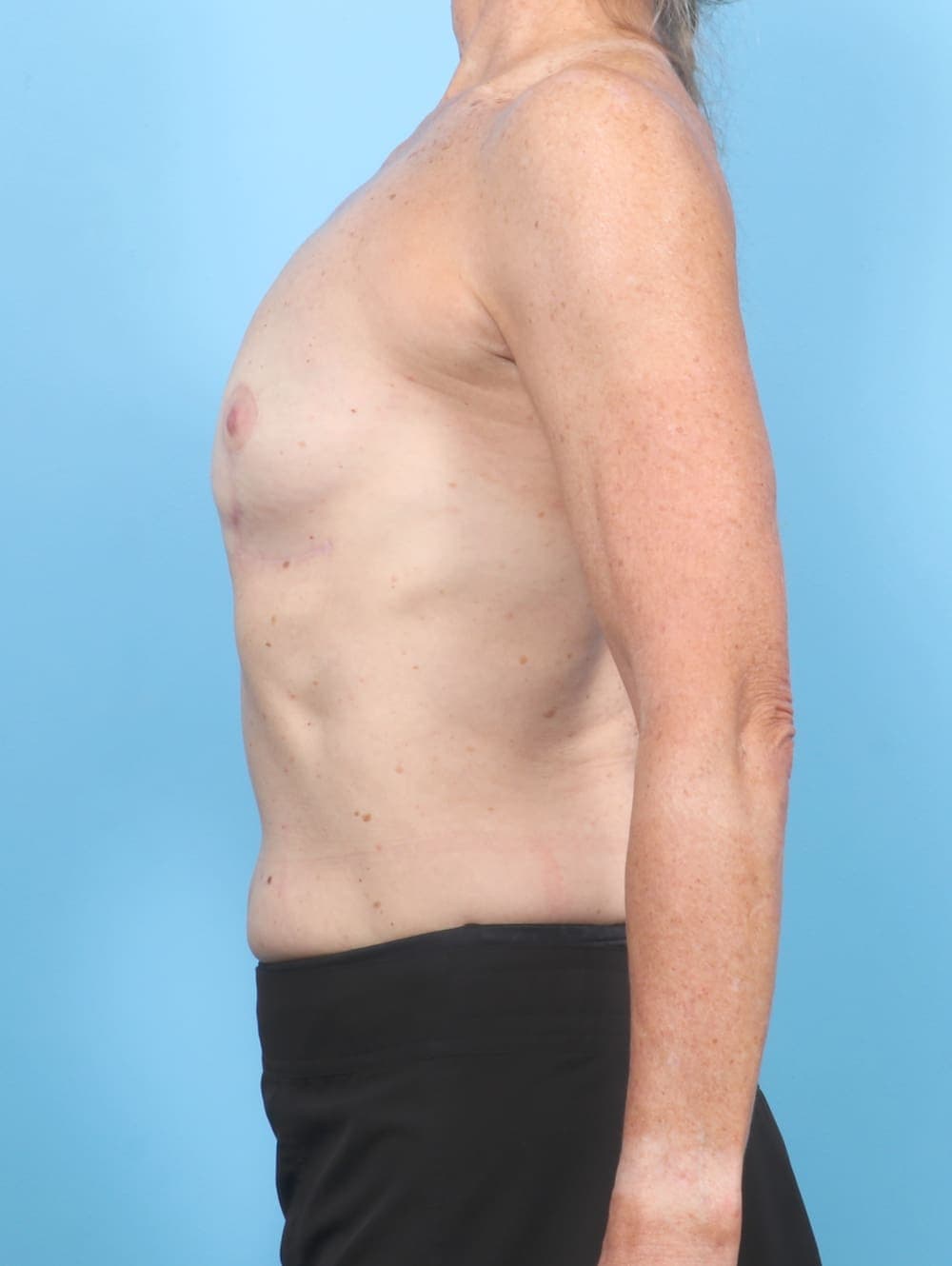 Breast Implant Removal with Lift case #6933 after, image 3