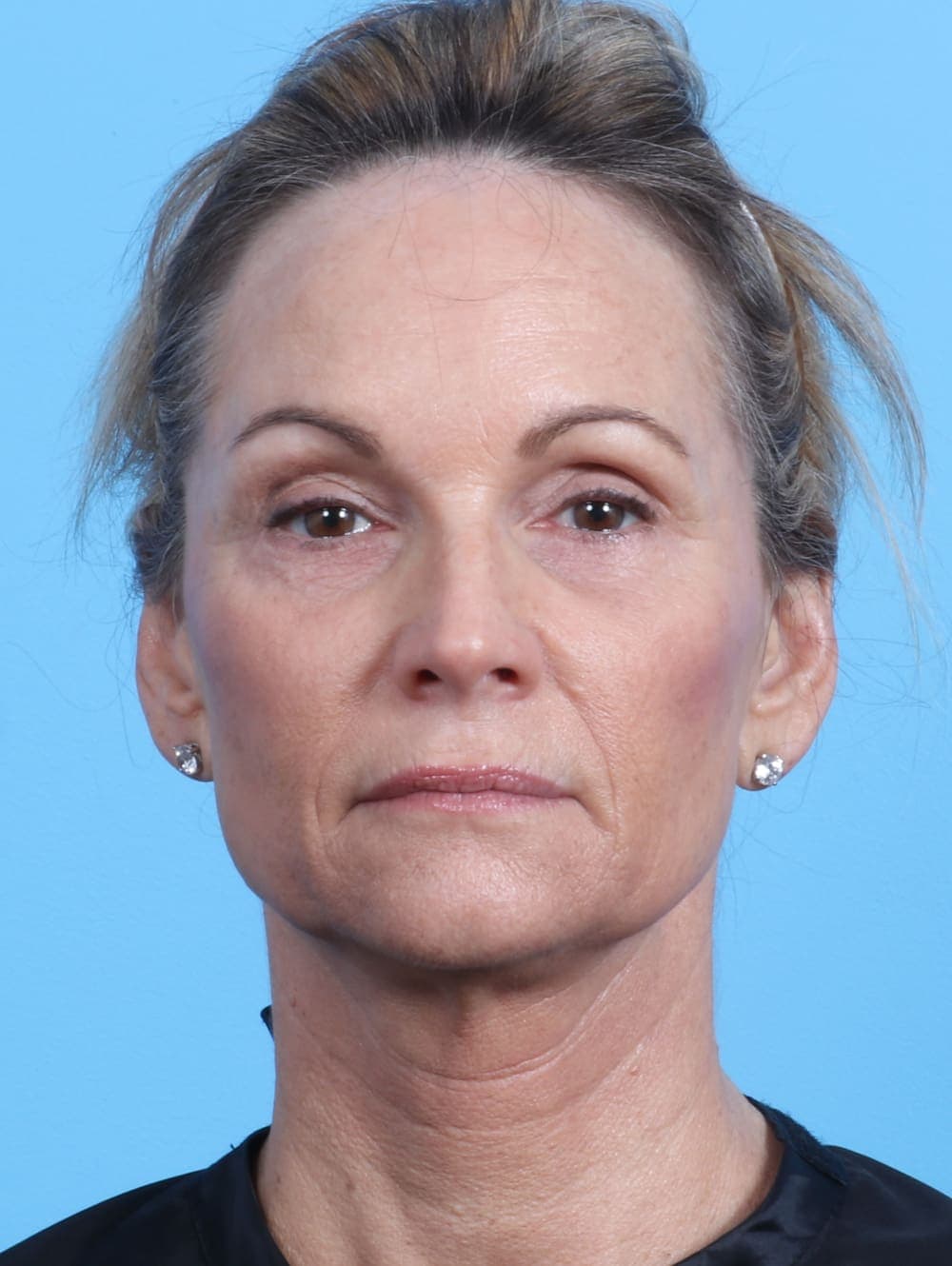 Eyelid Surgery case #2647 after, image 1
