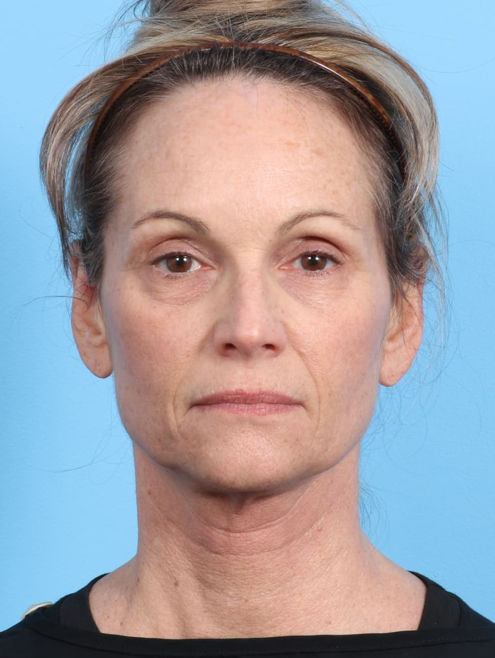 Eyelid Surgery case #2647 before, image 1