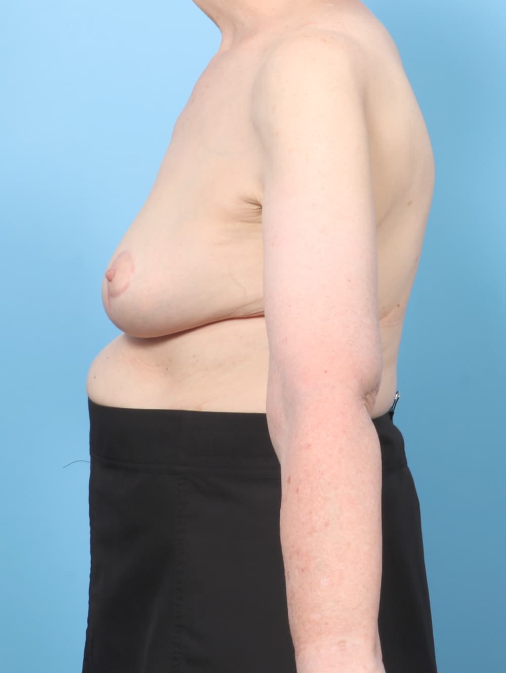 Breast Lift/Reduction case #8330 after, image 3