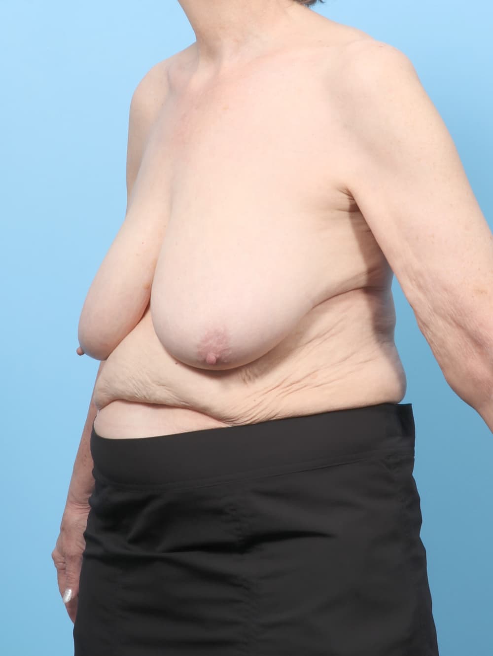 Breast Lift/Reduction case #8330 before, image 2