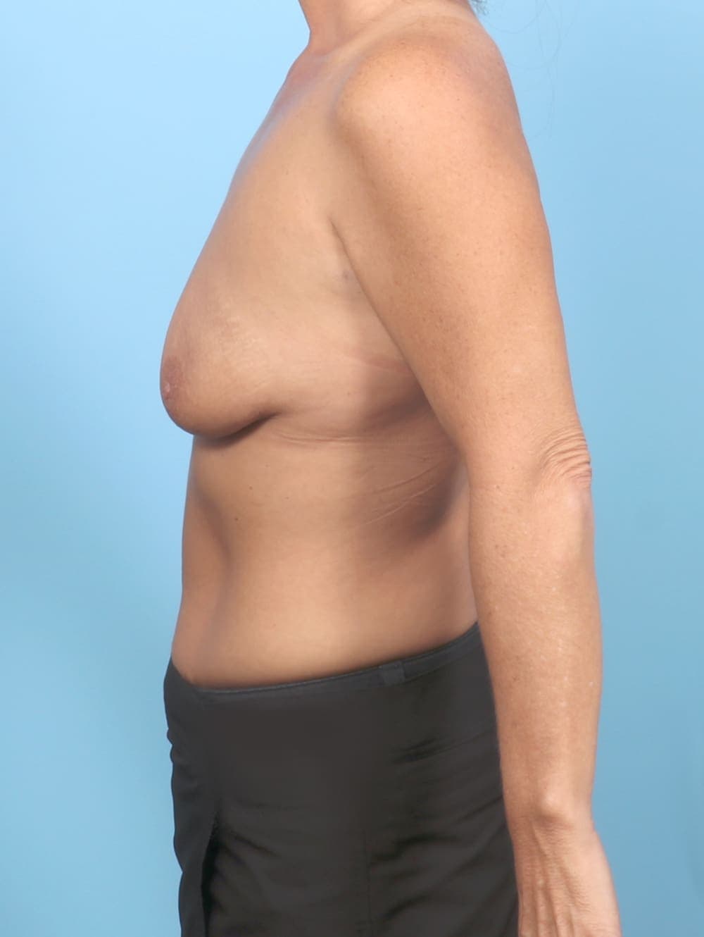 Breast Lift with Implants case #6803 before, image 3