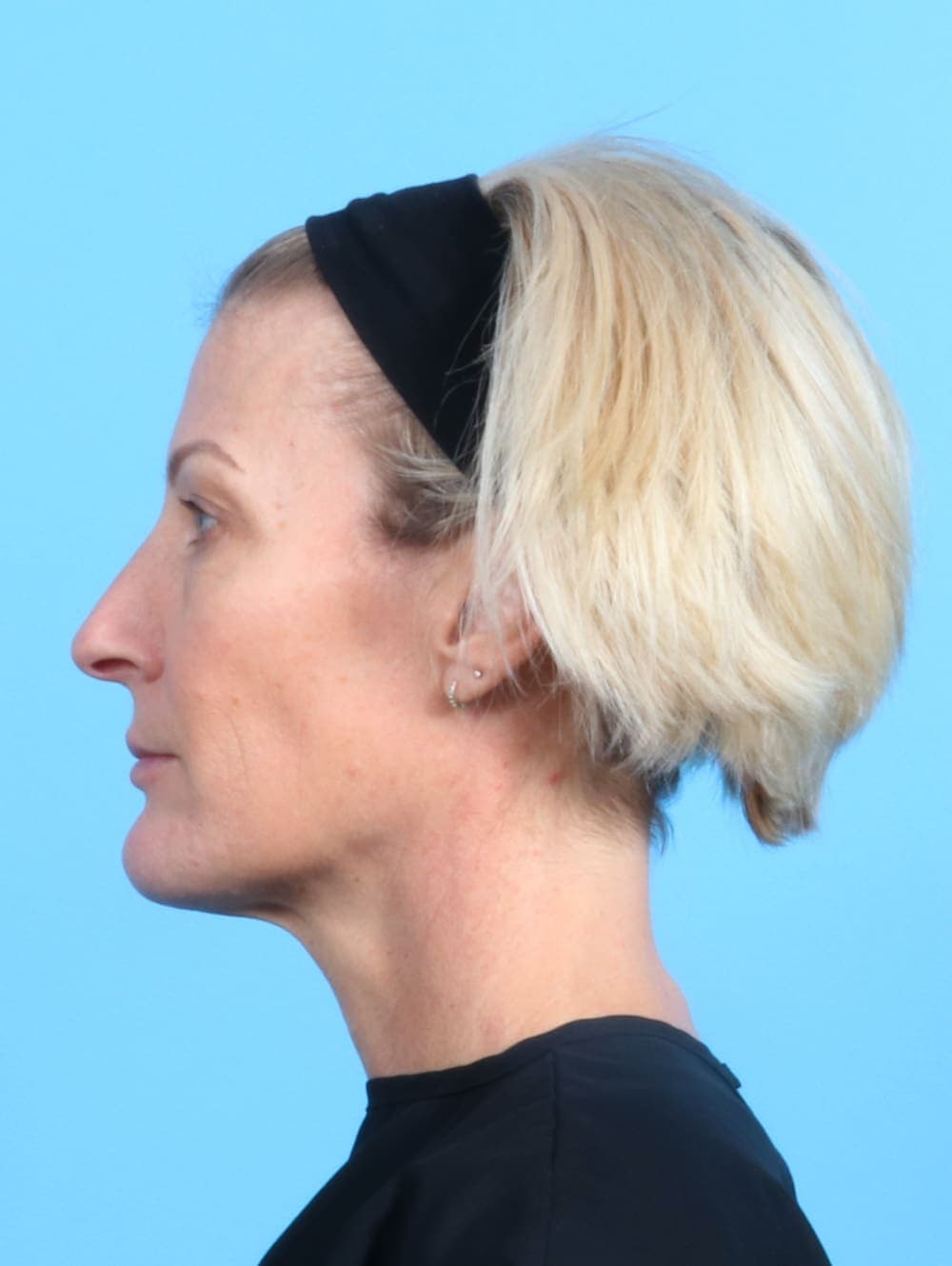 Eyelid Surgery case #2420 before, image 3