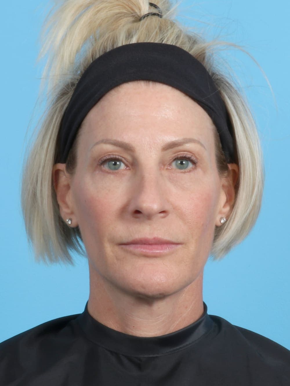 Eyelid Surgery case #2420 after, image 1
