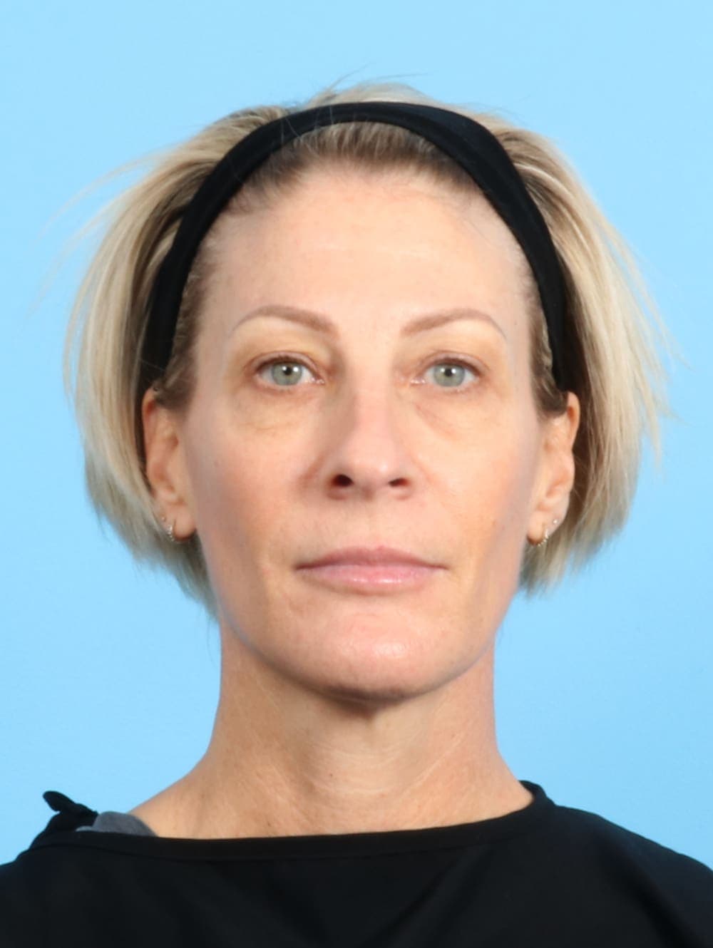 Eyelid Surgery case #2420 before, image 1
