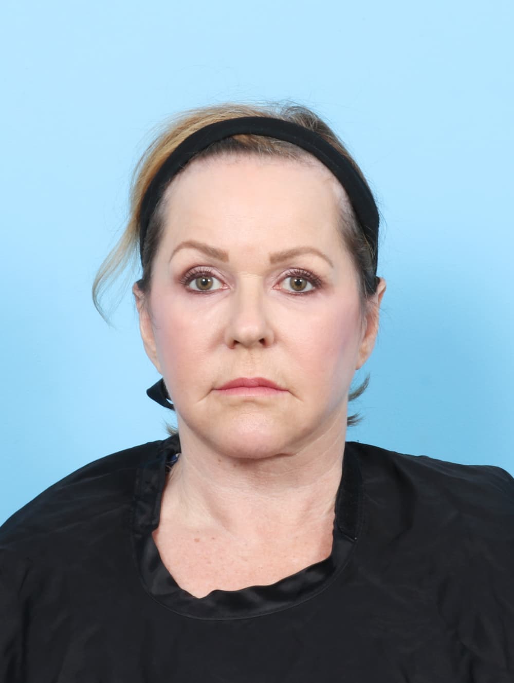 Facelift case #7509 after, image 1