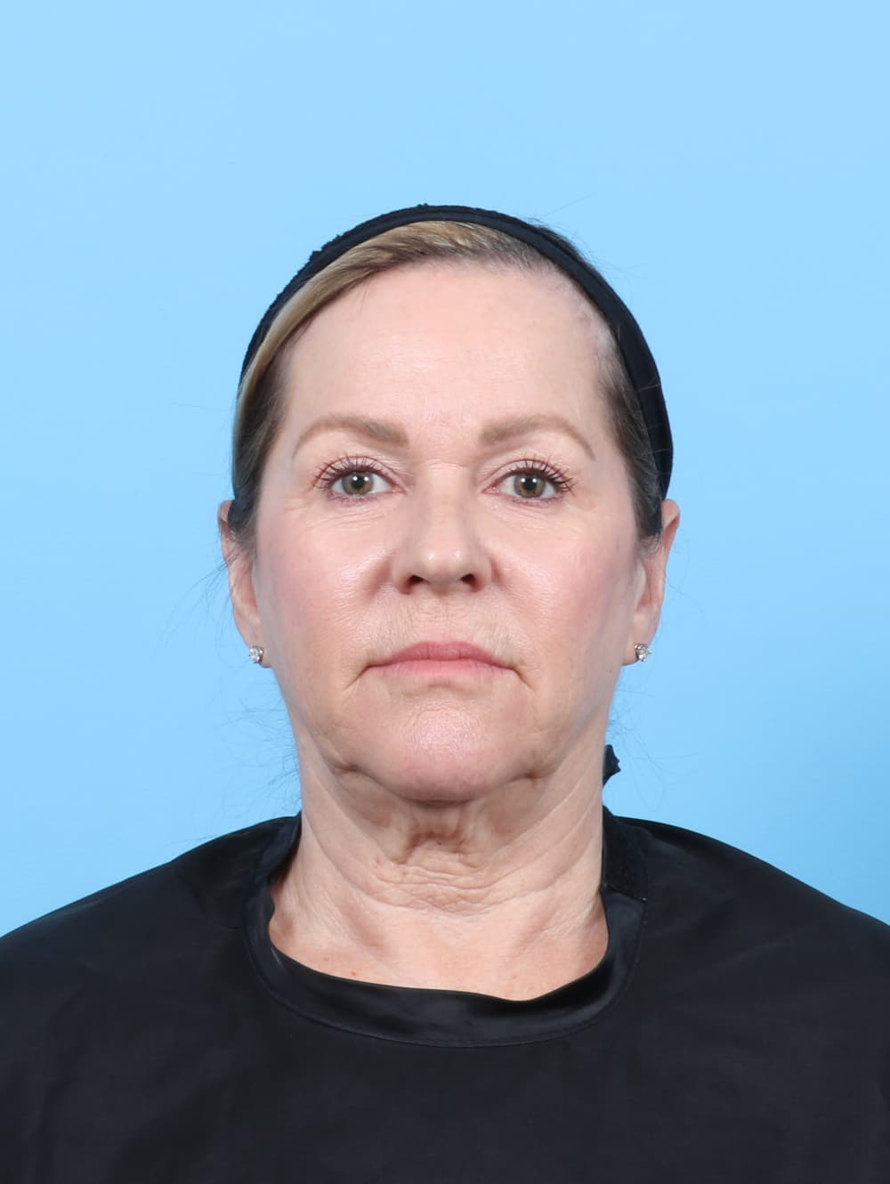Facelift case #7509 before, image 1