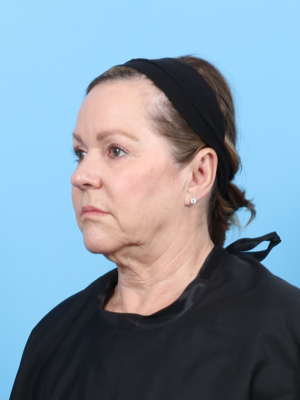 Facelift case #7509 before, image 2