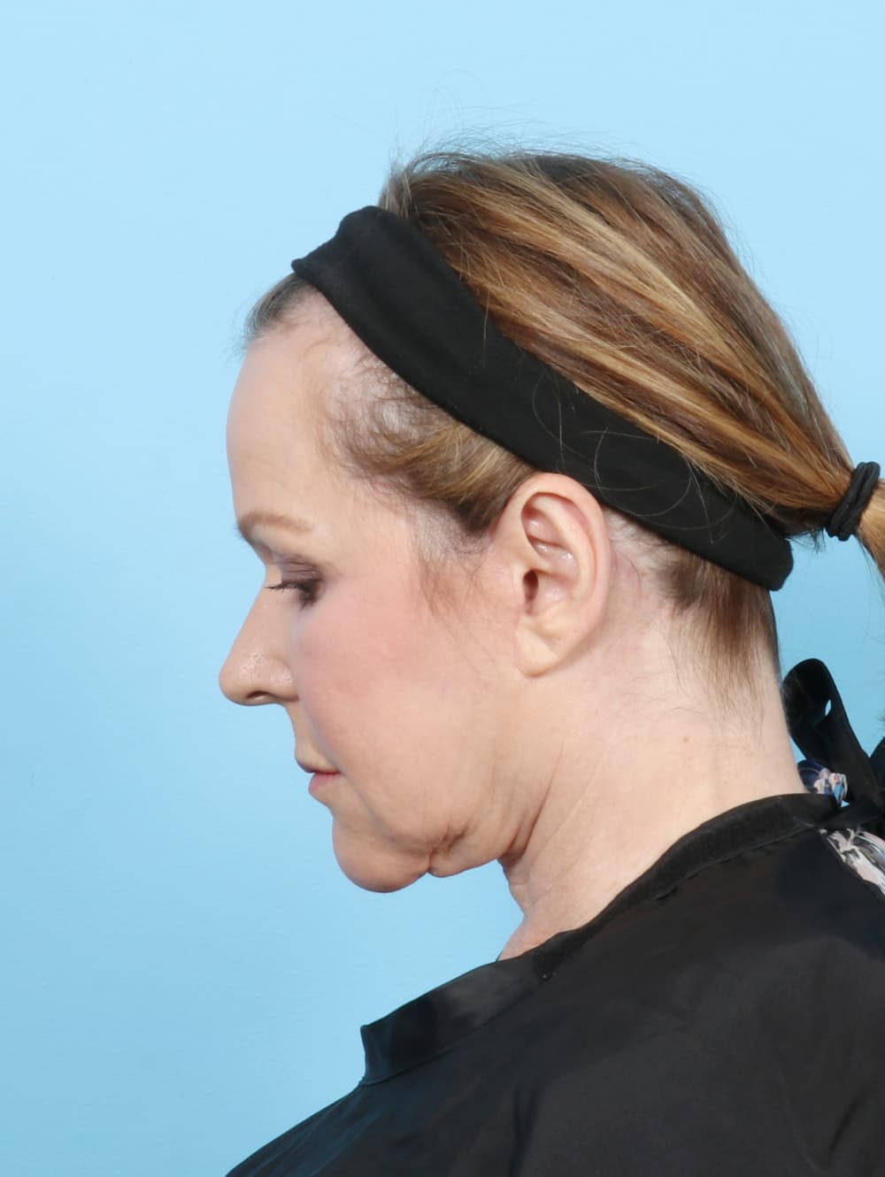 Facelift case #7509 after, image 4
