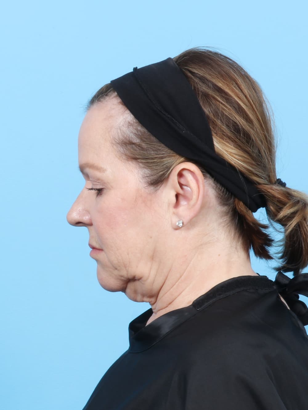 Facelift case #7509 before, image 4