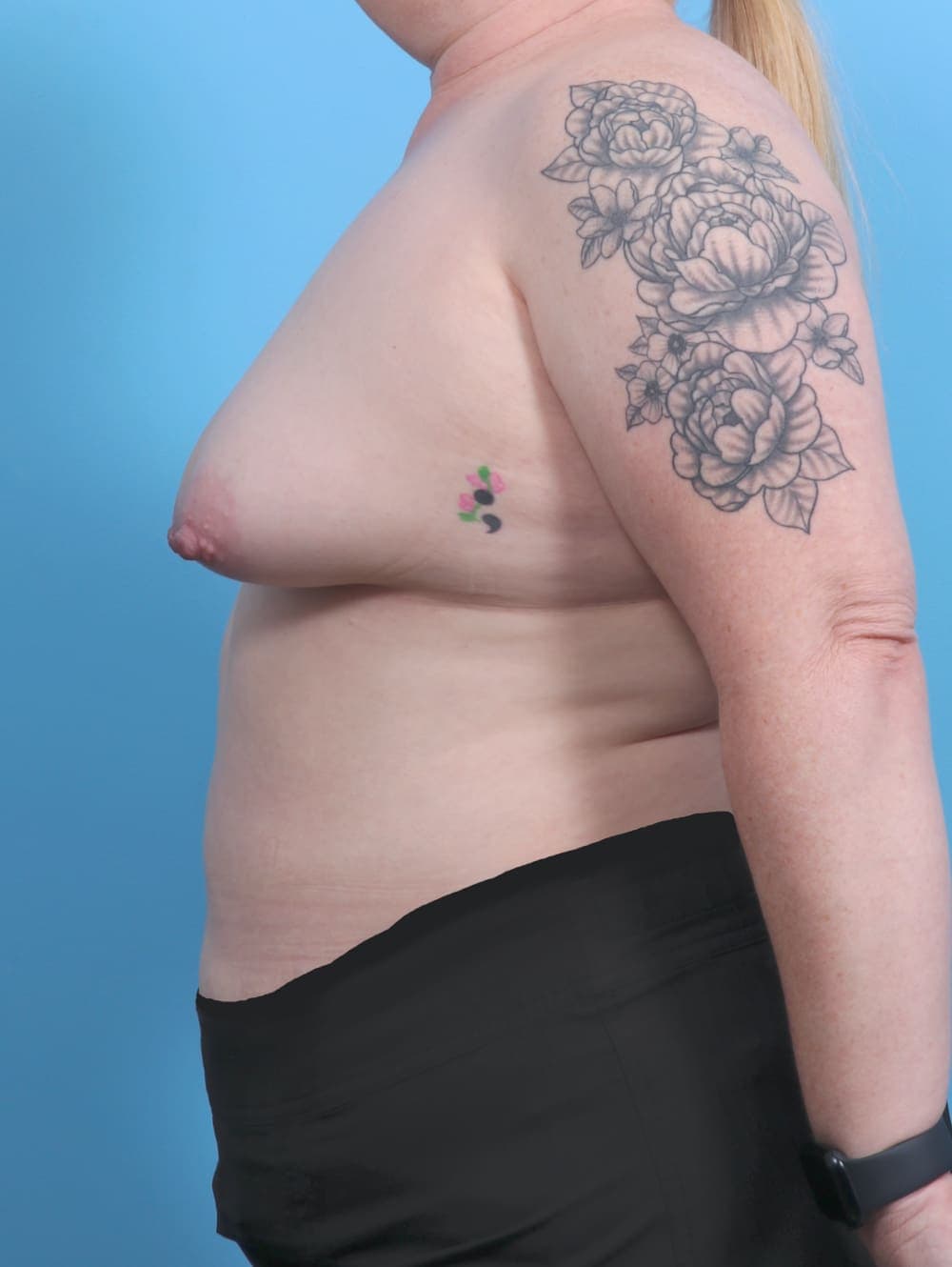 Breast Lift with Implants case #4363 before, image 3
