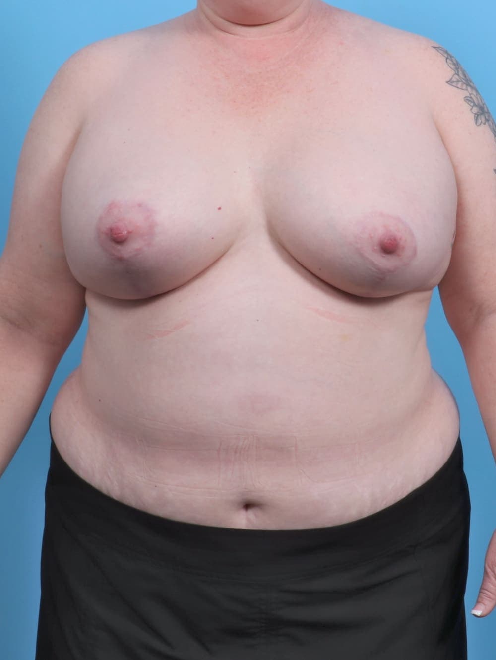 Breast Lift with Implants case #4363 after, image 1