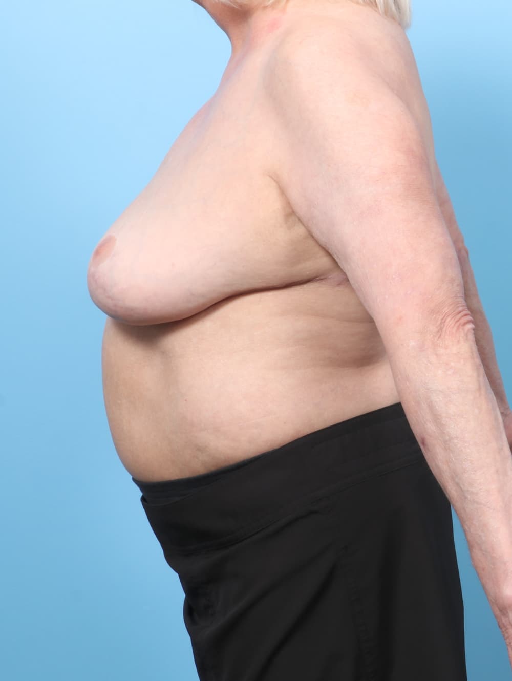 Breast Implant Removal with Lift case #8844 after, image 3