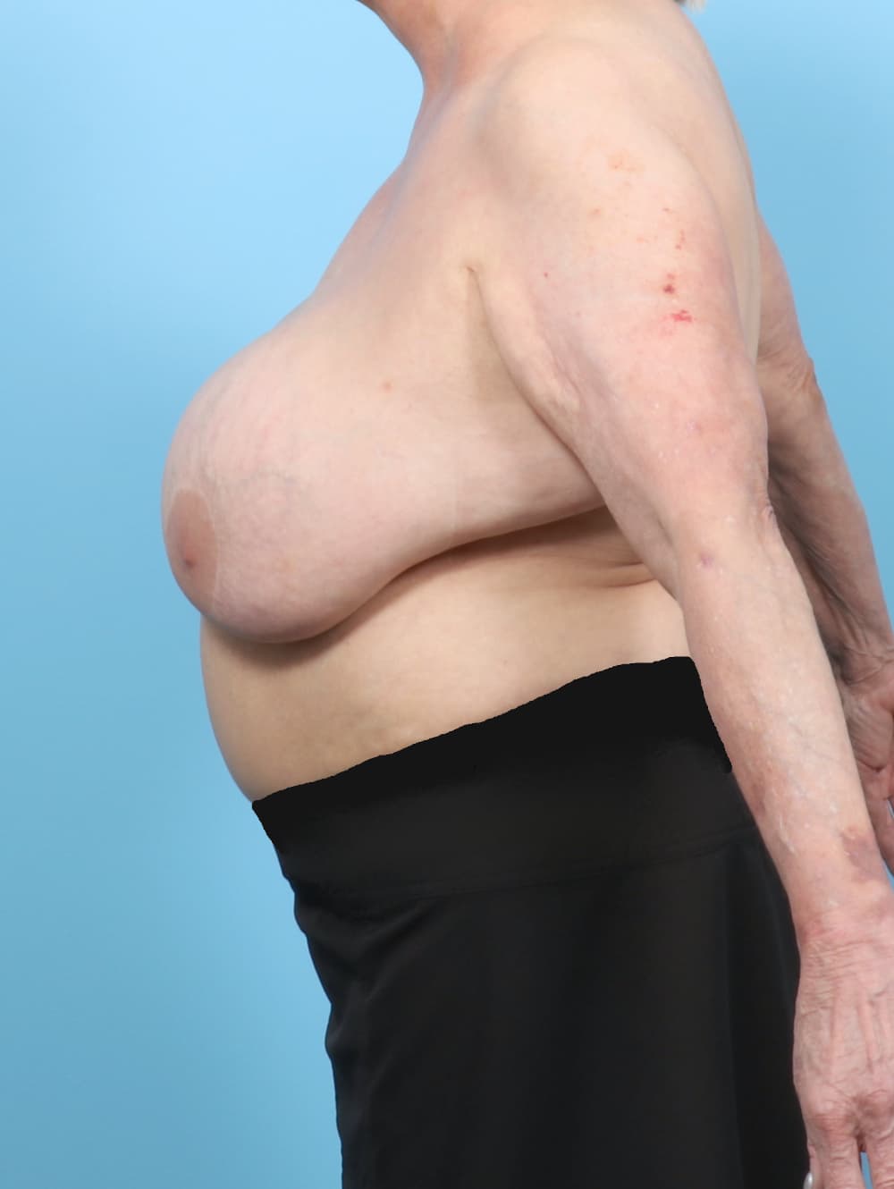 Breast Implant Removal with Lift case #8844 before, image 3