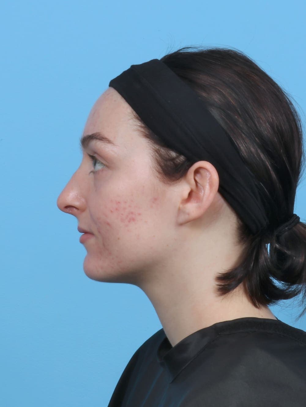 Rhinoplasty case #5103 after