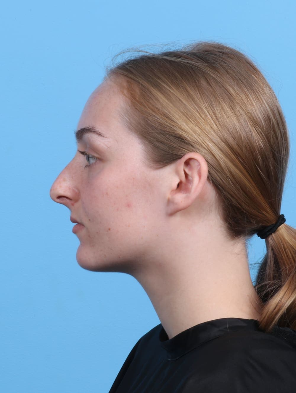 Rhinoplasty case #5103 before
