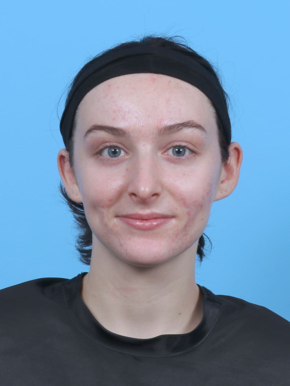 Rhinoplasty case #5103 after, image 2