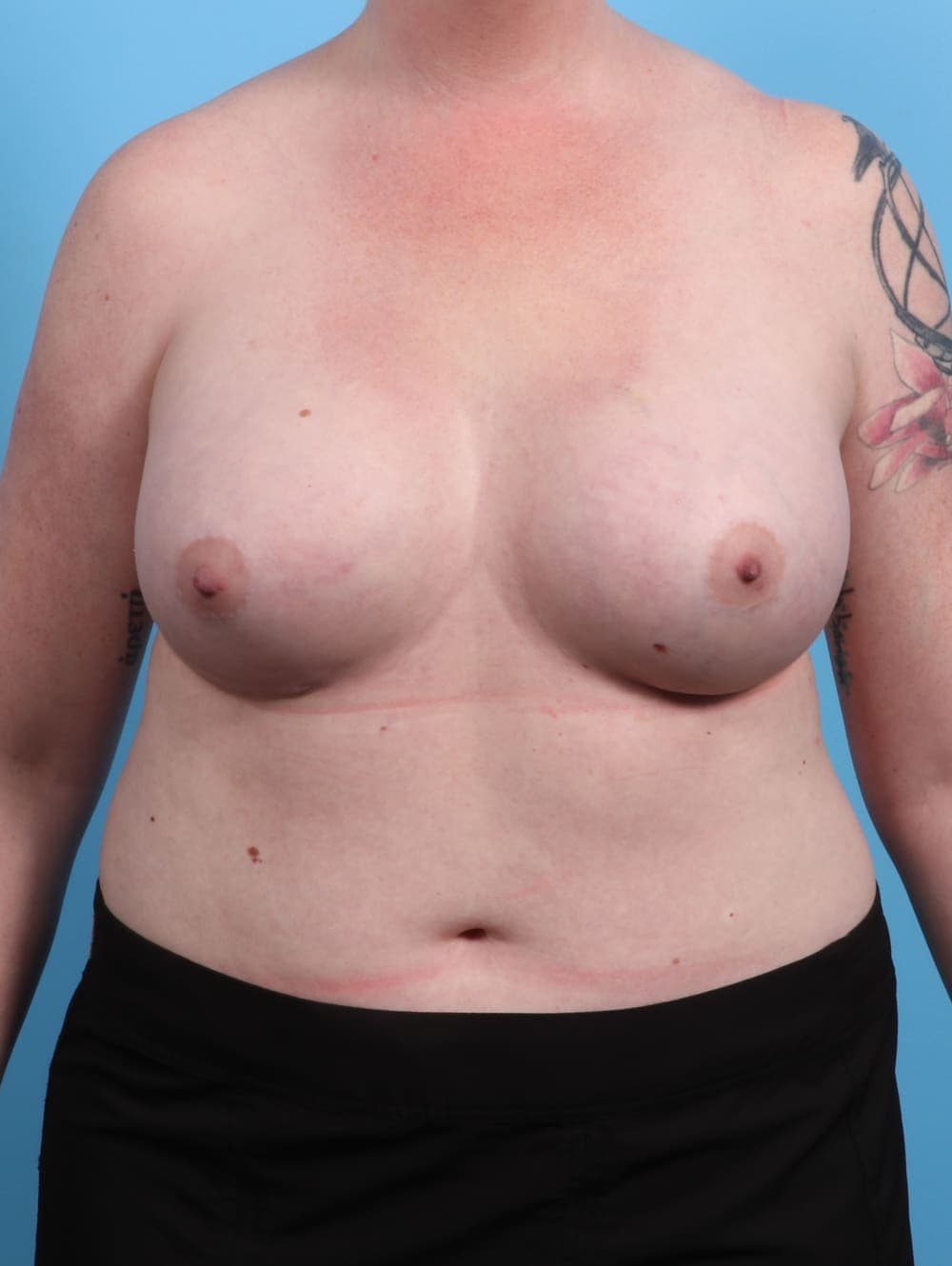 Breast Augmentation case #3287 after, image 1