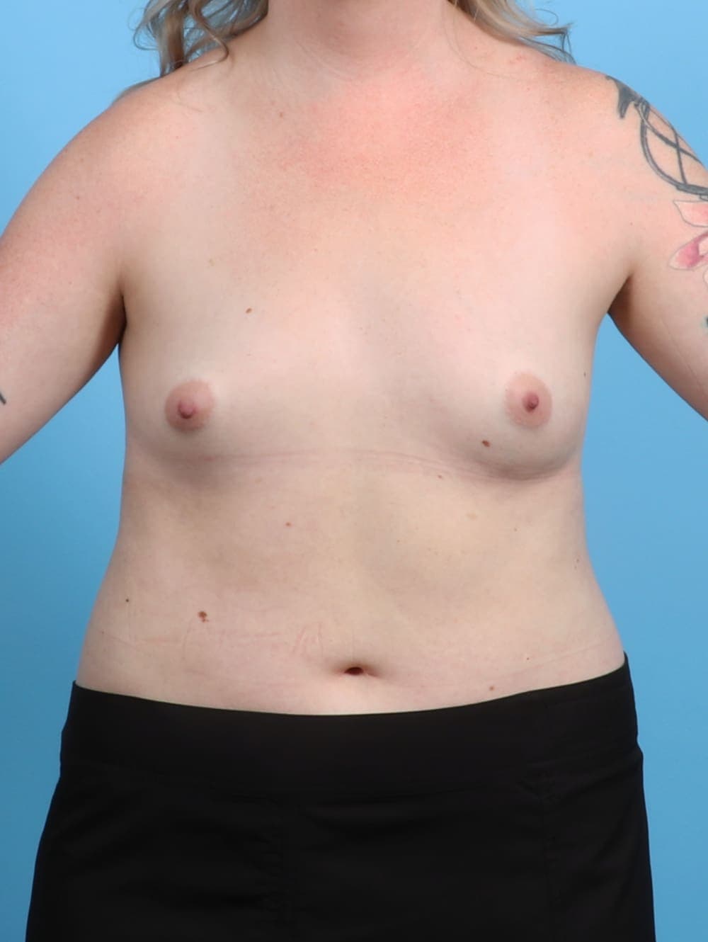 Breast Augmentation case #3287 before, image 1
