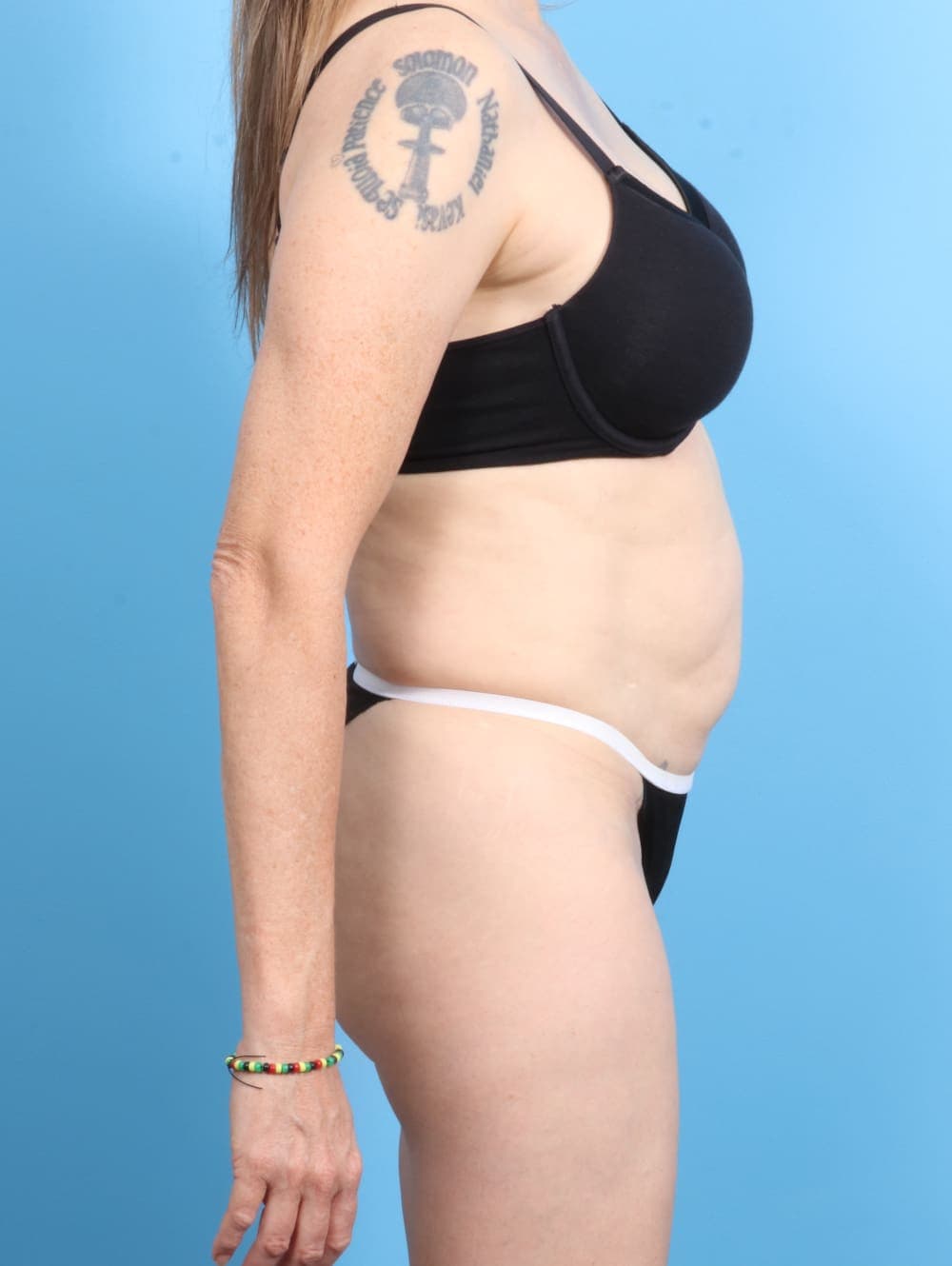 Tummy Tuck case #2282 before, image 3