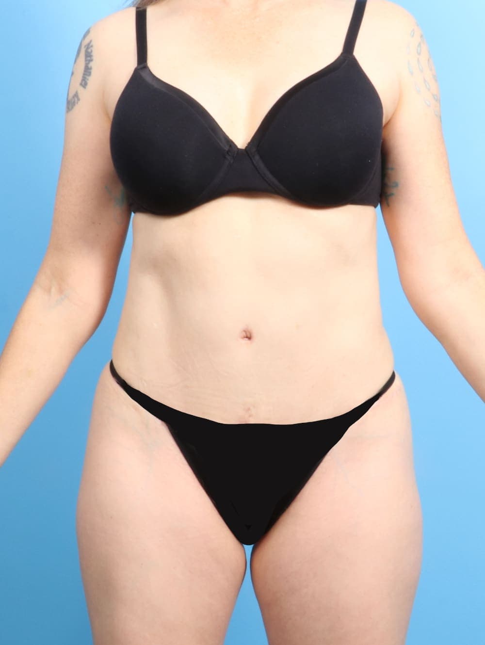 Tummy Tuck case #2282 after, image 1
