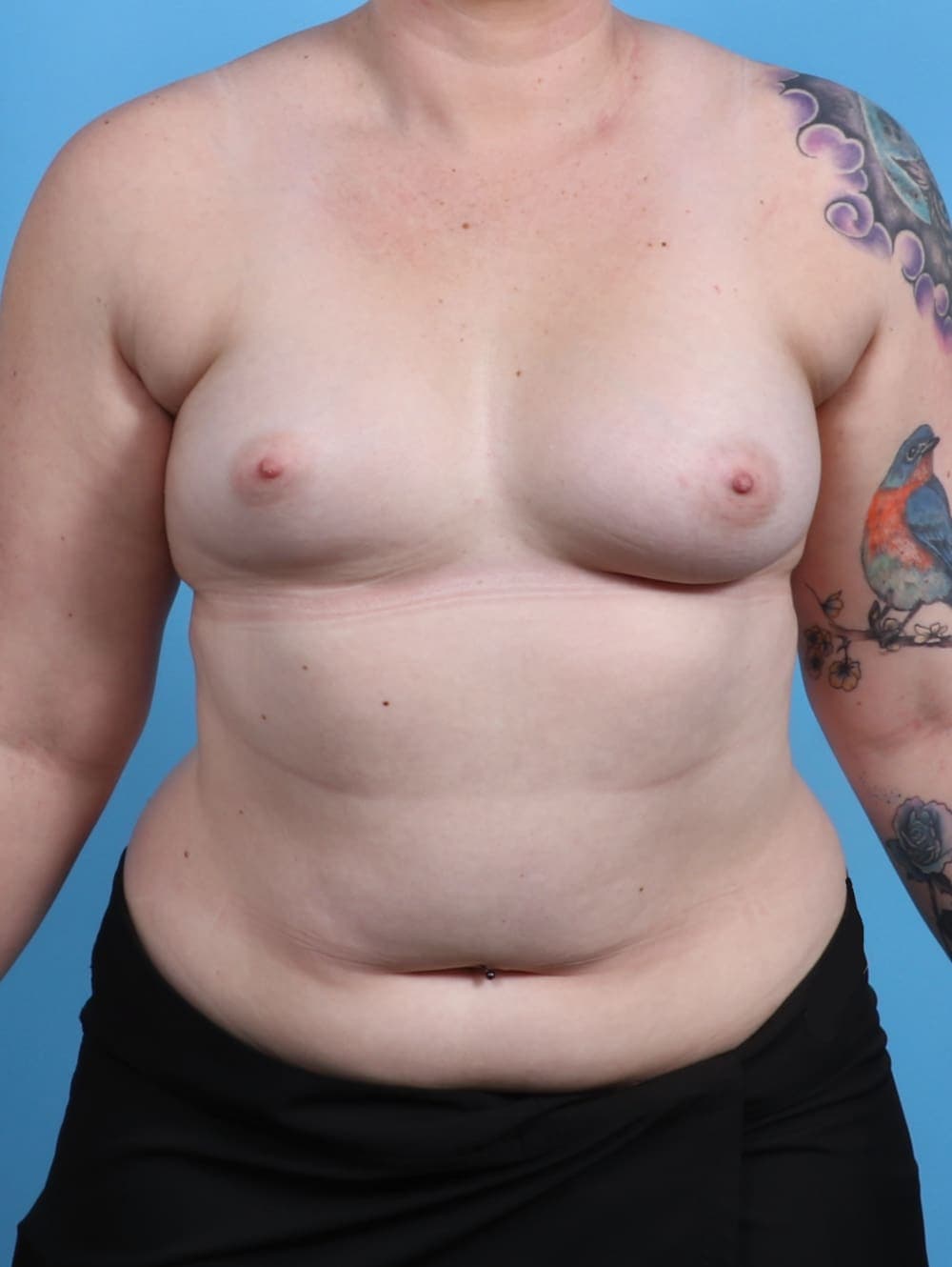 Breast Lift with Implants case #3864 before, image 1