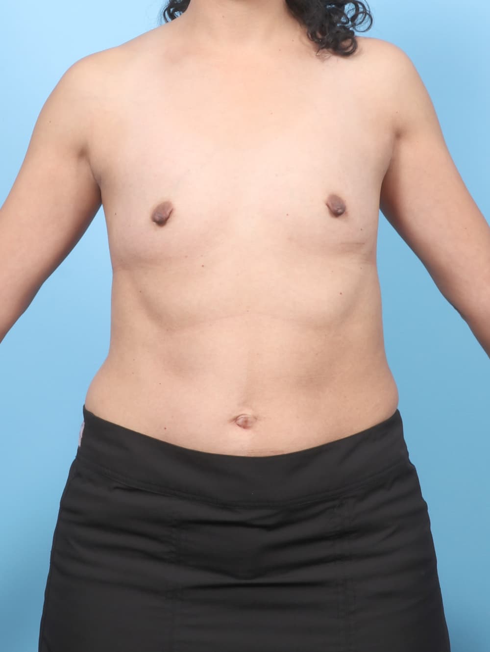 Breast Augmentation case #8110 before, image 1
