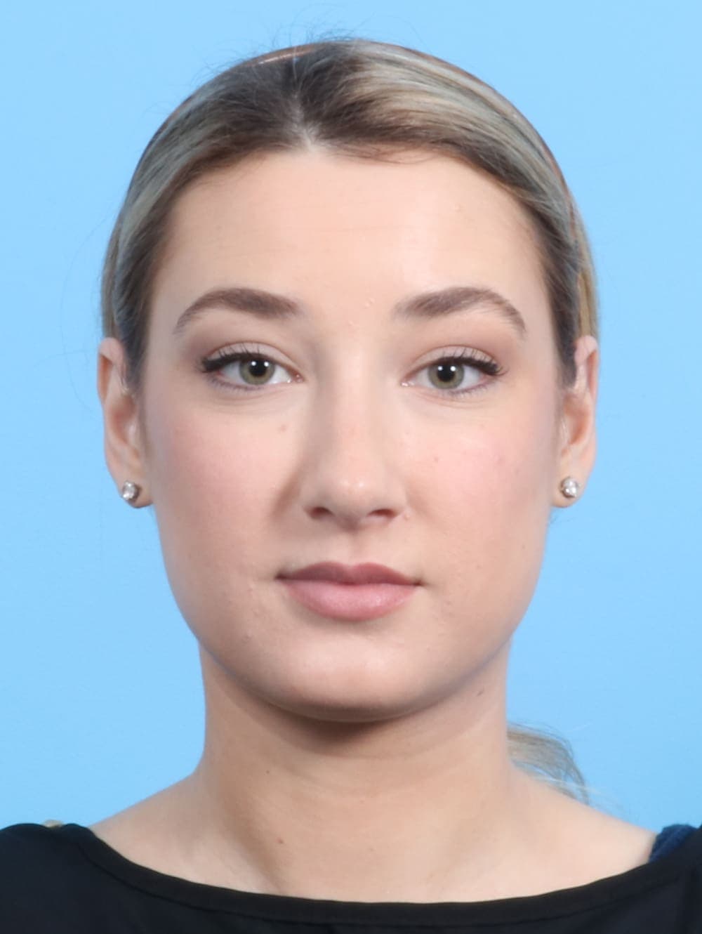 Rhinoplasty case #2240 after, image 2