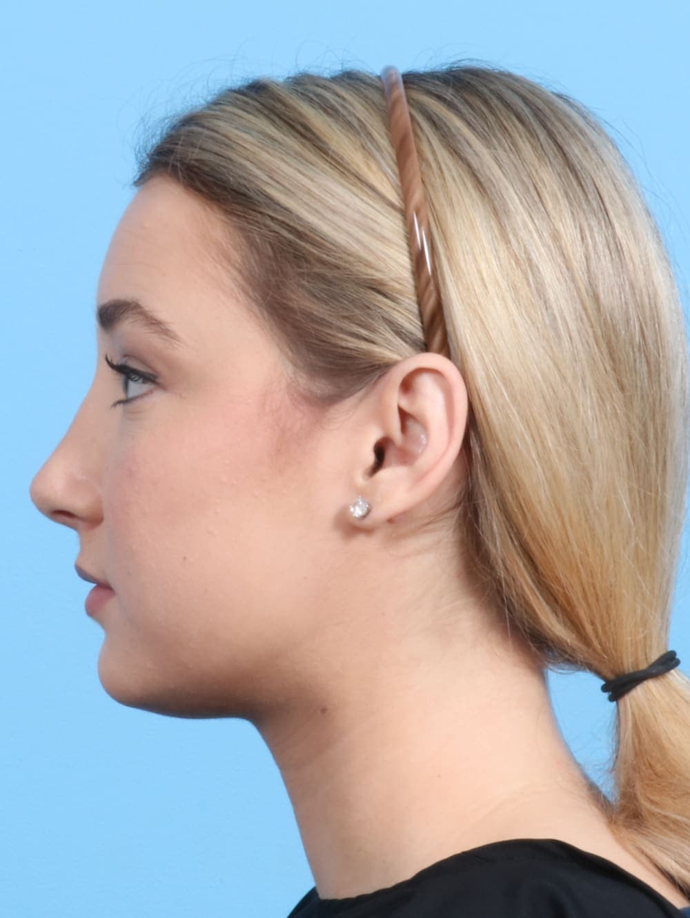 Rhinoplasty case #2240 after, image 1