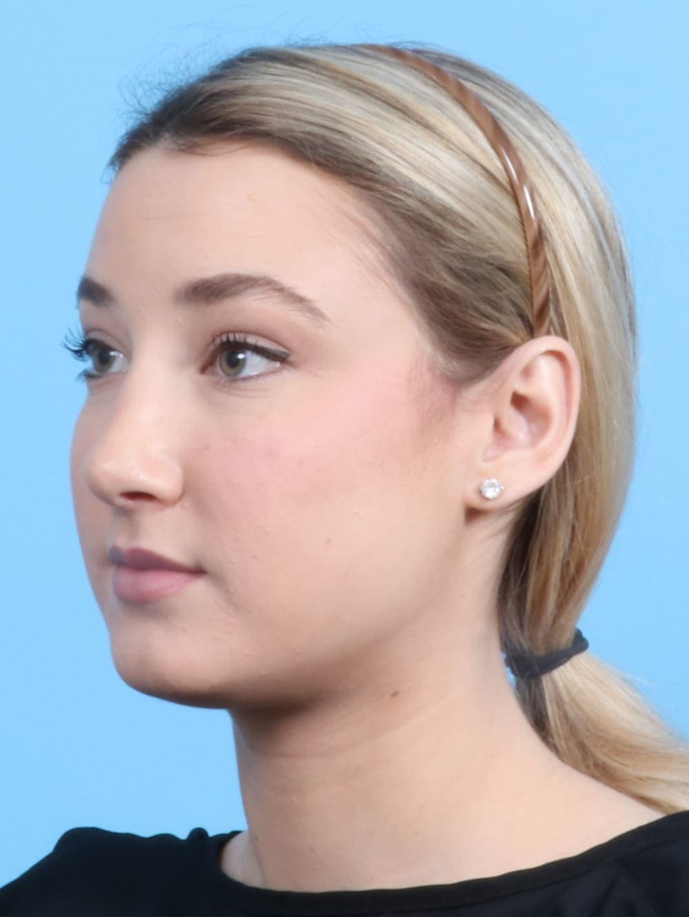 Rhinoplasty case #2240 after, image 3