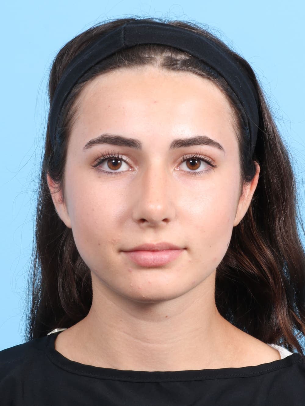 Rhinoplasty case #2679 after, image 2
