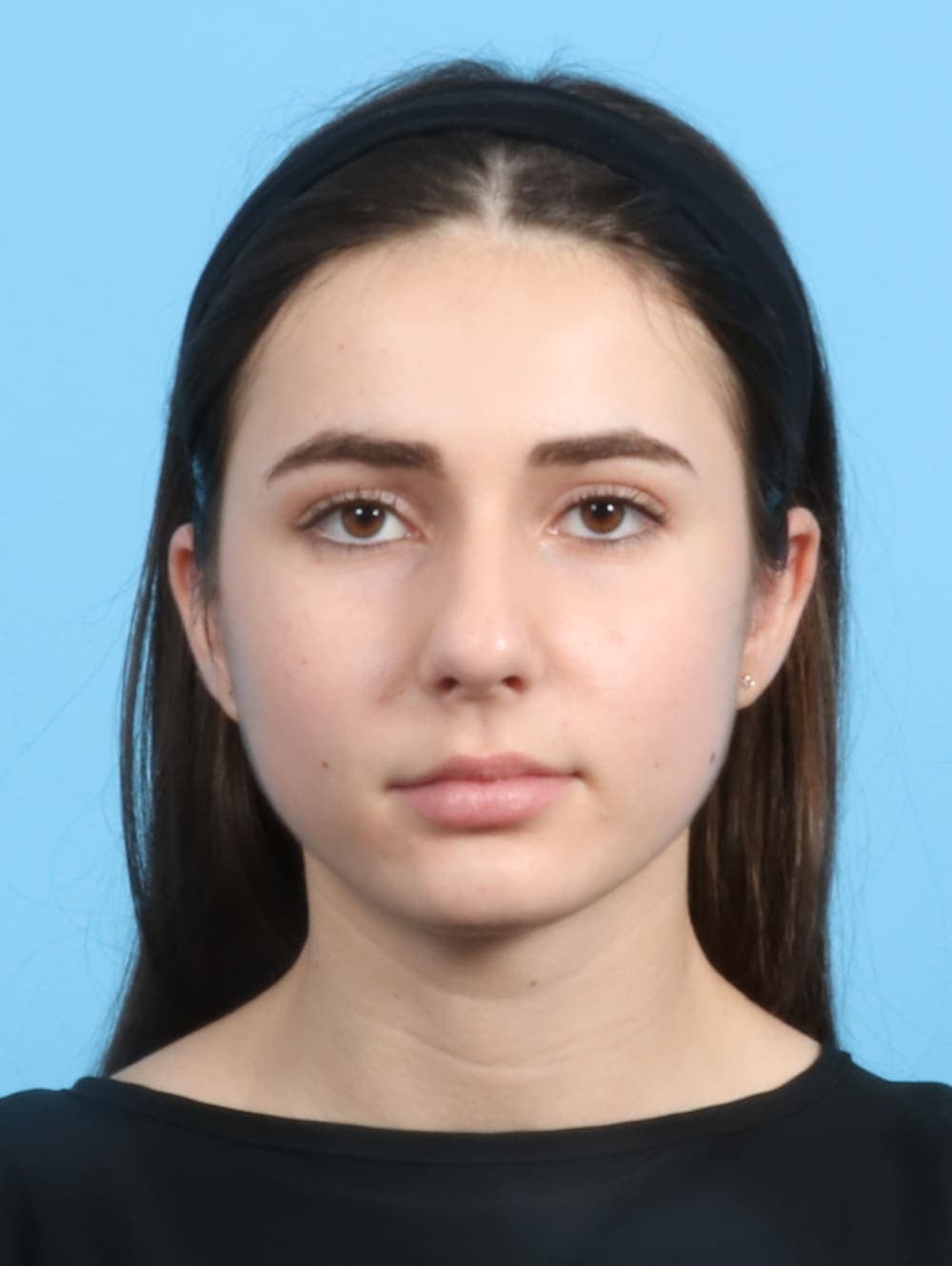Rhinoplasty case #2679 before, image 2