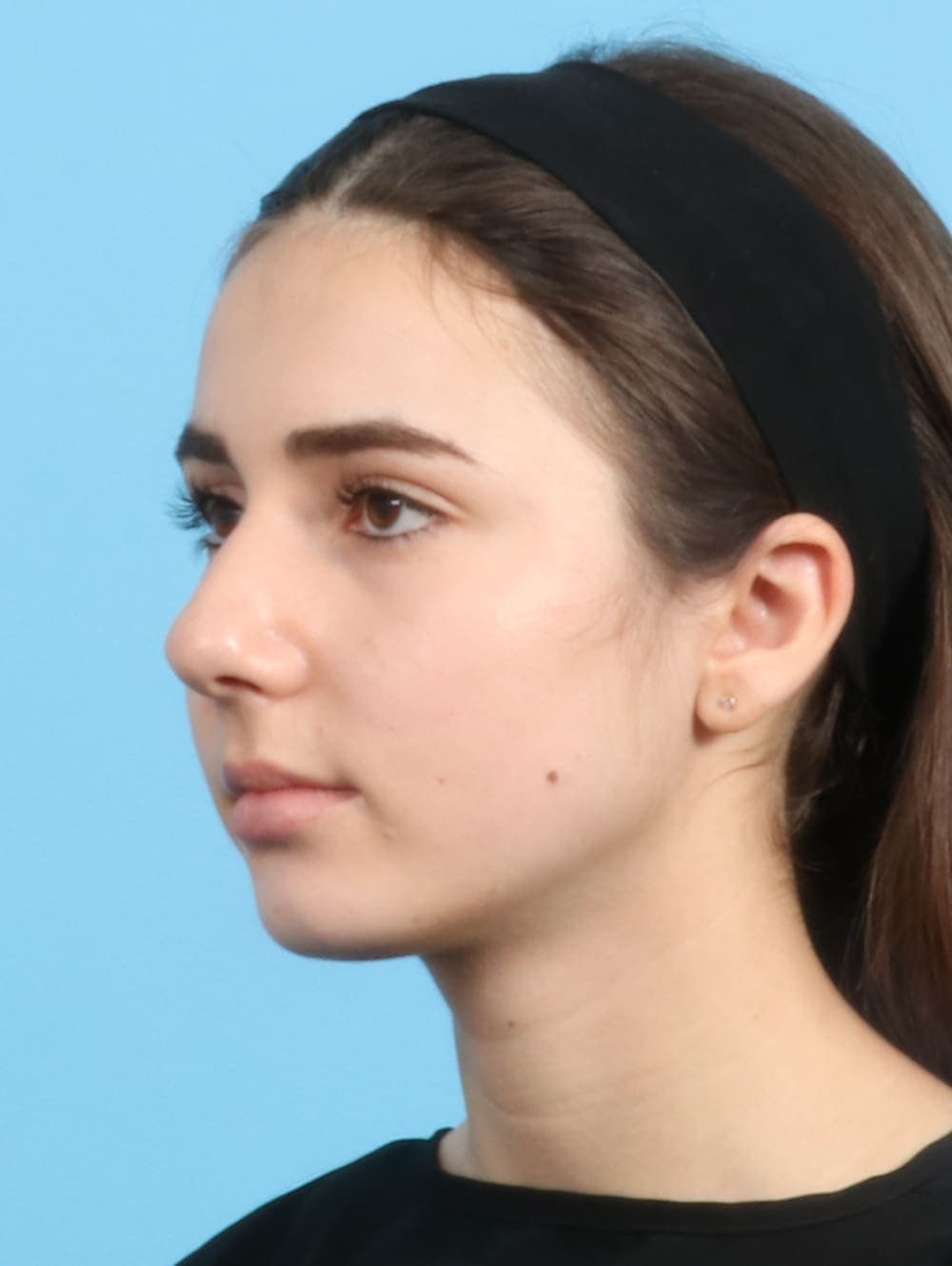 Rhinoplasty case #2679 before, image 3